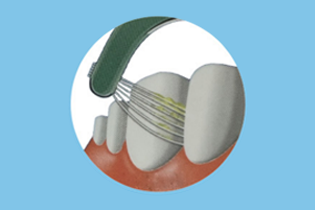 Tehnologia Buletedan